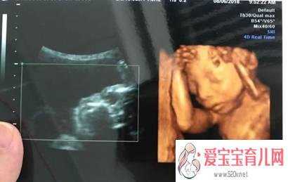 <b>四维胎儿双侧肾盂无分离是男是女,5个月</b>